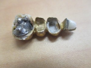 金歯