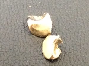 芦屋 金歯 買取 甲南山手