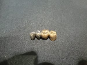 歯科材料（金歯）をお買取りしました☆大吉伊勢ララパーク店です☆彡