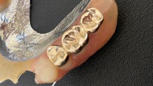 金歯も買取できちゃいます!大吉アクロスモール春日店